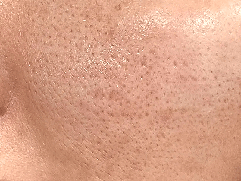 Congested Pores